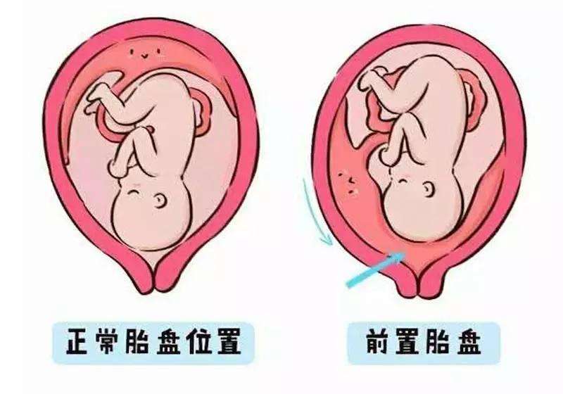 汉中华西妇产医院|胎盘位于子宫前壁正常吗？